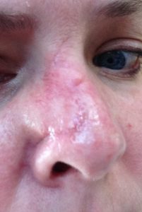 mohs surgery, nose