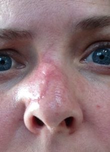mohs surgery, nose