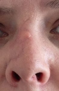 mohs surgery, nose