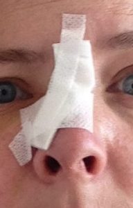 mohs surgery, nose