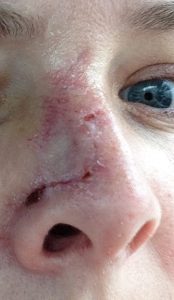 mohs surgery, nose