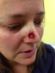 mohs surgery, nose